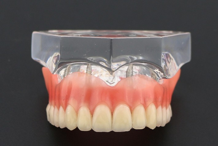 Dental Teeth Implant Overdenture Model Upper Jaw With 4 Implants Study Demo Model 6001